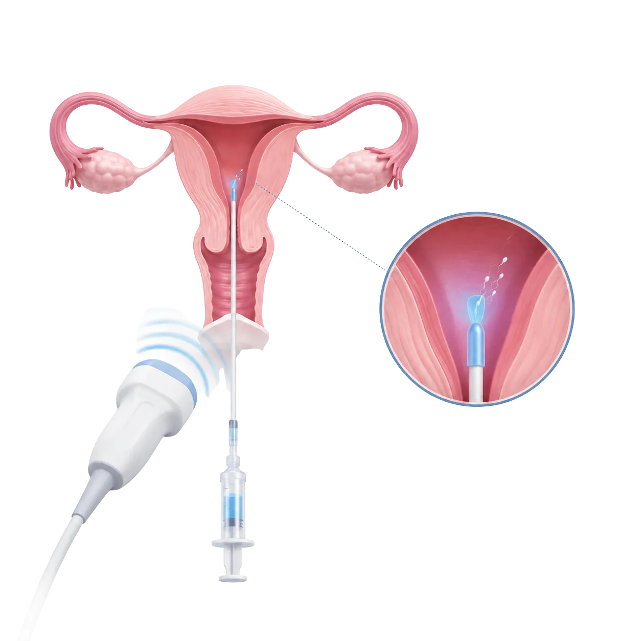 Inseminación